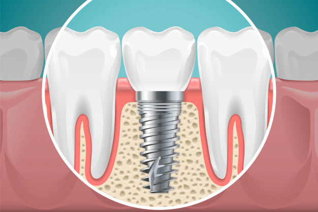 After Dental Implant