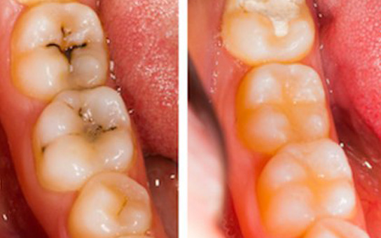 Restorative Dentistry in Vizag